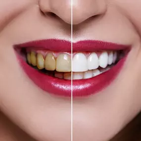 Smile Makeover