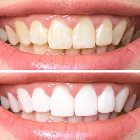 Zoom Teeth Whitening