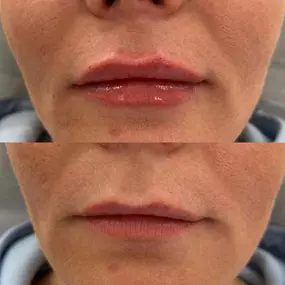 Ridgefield Aesthetics offers advanced aesthetic treatments, including dermal fillers, laser skin revitalization, and body contouring, led by Dr. Zina Boutaeva and her expert team. Prioritizing comfort, safety, and personalized care, they help clients achieve radiant skin and enhanced confidence. Visit us near downtown Ridgefield, CT.