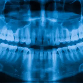 Dental X-rays are a crucial tool for detecting issues that aren't visible to the naked eye, like cavities between teeth, bone loss, and hidden infections. Schedule an X-ray today if you feel any pain or aching in your teeth.