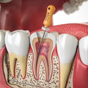 If you're dealing with severe tooth pain or infection, endodontic treatment might be the solution. Our skilled specialists use the latest techniques to remove infections and preserving your natural tooth, and relieve discomfort. Don't let tooth pain keep you from enjoying life, schedule an appointment today!