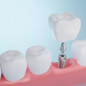 Dental implants offer a permanent solution that looks and feels like natural teeth. Our experienced team will work with you to create a personalized treatment plan, helping restore both function and confidence in your smile. Say goodbye to gaps and hello to a full, beautiful set of teeth.