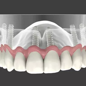 Progressive Periodontics and Implant Dentistry, led by Dr. Marc Gordon, offers periodontal and dental implant care in Monmouth County. Voted a Top NJ Periodontist for over a decade, Dr. Gordon uses advanced technologies like CBCT imaging, laser therapy, sedation, and regenerative procedures to deliver precise, high-quality care. 
Working with your dental providers we ensure seamless care—no referral is needed. Whether you need a second opinion, or flexible financing, we’re here to help.