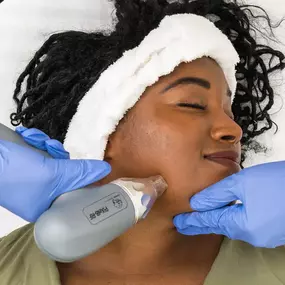 woman receiving microneedling treatment