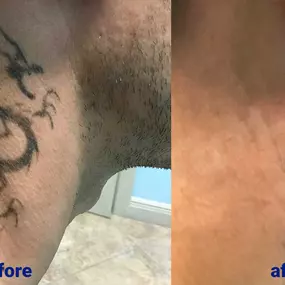 Bild von TakeTatt Tattoo Removal