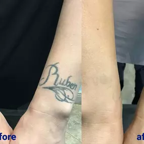 Bild von TakeTatt Tattoo Removal