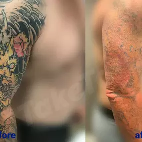 Bild von TakeTatt Tattoo Removal