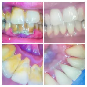 Before & After Smile Makeover at Agape Dental in Rocklin, CA - Dr. Mignon Mapanao