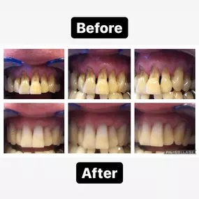 Before & After Smile Makeover at Agape Dental in Rocklin, CA - Dr. Mignon Mapanao