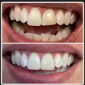 Before & After Smile Makeover at Agape Dental in Rocklin, CA - Dr. Mignon Mapanao