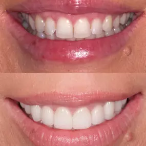 Dentist in Cupertino
PENINSULA CENTER FOR COSMETIC DENTISTRY - CUPERTINO
10055 N PORTAL AVE STE 100
CUPERTINO CA 95014
http://www.pccdsmiles.com/