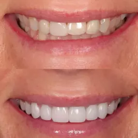 Dentist in Cupertino
PENINSULA CENTER FOR COSMETIC DENTISTRY - CUPERTINO
10055 N PORTAL AVE STE 100
CUPERTINO CA 95014
http://www.pccdsmiles.com/