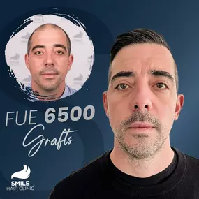 Bild von Smile Hair Clinic – Ihr NRW-Ansprechpartner für Haartransplantationen in der Türkei