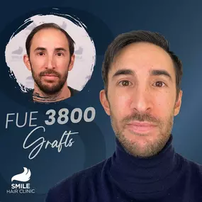 Bild von Smile Hair Clinic – Ihr NRW-Ansprechpartner für Haartransplantationen in der Türkei