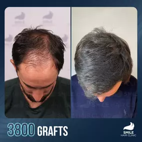 Bild von Smile Hair Clinic – Ihr NRW-Ansprechpartner für Haartransplantationen in der Türkei