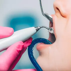 estudio-dental-abascal-limpieza-dental.jpg