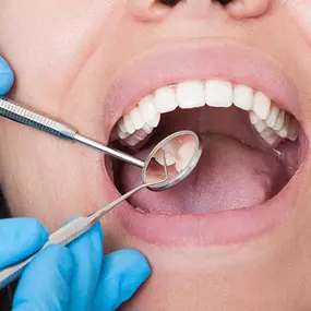 caries-dentales-clinica-lorenzo-zaragoza.jpg