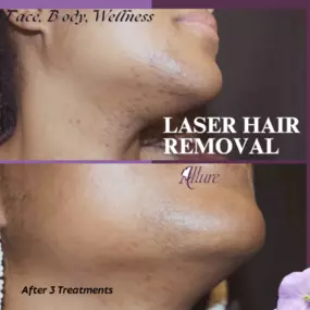facial laser hair removal