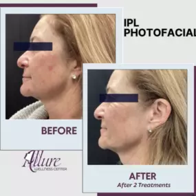 IPL Photofacial