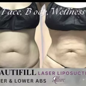 Laser Liposuction