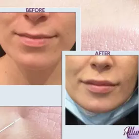 Lip Filler