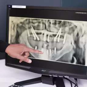 Bild von ArchONE Full Arch Implants