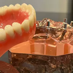 Dental Implants