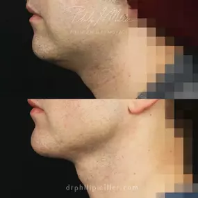 Necklift and Chin Implant to Lift and Tighten the Skin around the Face and Neck