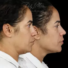 MicroLift - Face, Neck & Jaw to elevate cheeks define jawline