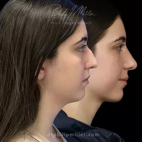 Rhinoplasty to remove dorsal hump and elevate tip