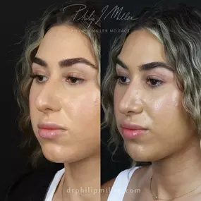 Rhinoplasty to remove dorsal hump and elevate tip