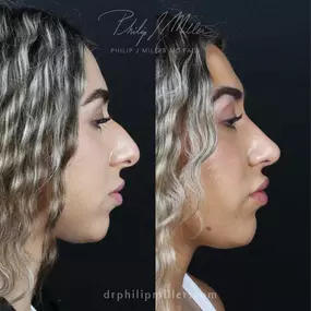Rhinoplasty to remove dorsal hump and elevate tip