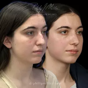 Rhinoplasty to remove dorsal hump and elevate tip