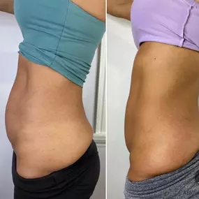 This powerful before-and-after image demonstrates the results of a medical weight loss program at RAVE Clinics in Littleton, CO. Clients undergoing this physician-supervised program often see targeted fat reduction and body contour improvement through a comprehensive approach involving GLP-1 medications (like semaglutide), nutritional guidance, and lifestyle support. RAVE’s individualized programs focus on long-term health, not just quick fixes—empowering clients to reach and maintain their goal