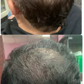 Fancy Hair Gerardo's - Antes y el despues de usar shampoo para la caída del cabello