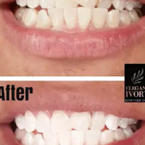Bild von Elegant Ivory Beauty / Teeth Whitening