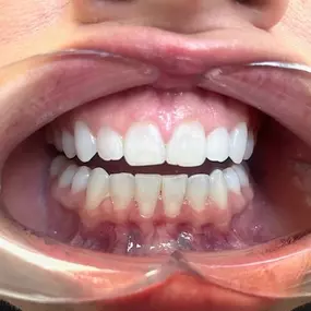 Invisalign and whitening treatment