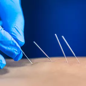 You can rely on our team to assess if dry needling is the right option for your overall health and well-being.
