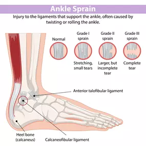 Grading of ankle ligament tear