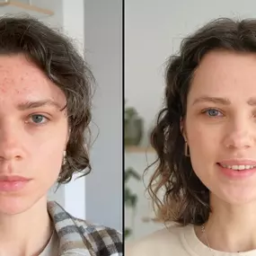 Get rid of acne and achieve clear skin today.