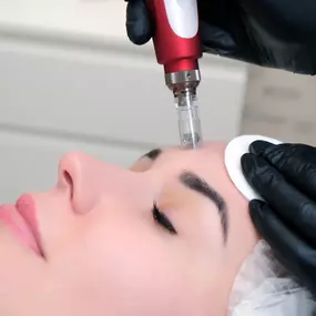 Dermapen micro-needling treatment