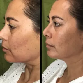 Liquid Facelift