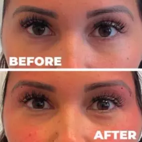 Dermal Filler