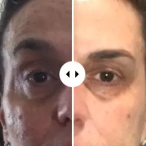 Laser Resurfacing