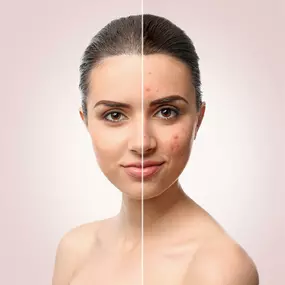 Scar Revision Surgery