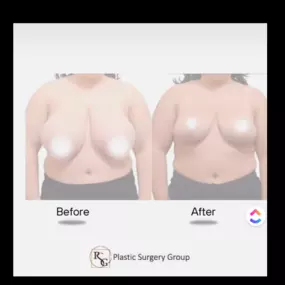 Before and After Breast Reduction