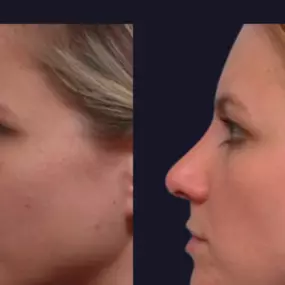 Before and after a nose job