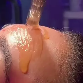 Microneedling