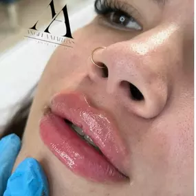 ACIDO-HIALURONICO-LABIOS-SAN-SEBASTIAN-DE-LOS-REYES.jpg