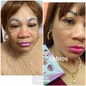 AUMENTO-LABIOS-SAN-SEBASTIAN-DE-LOS-REYES.jpg